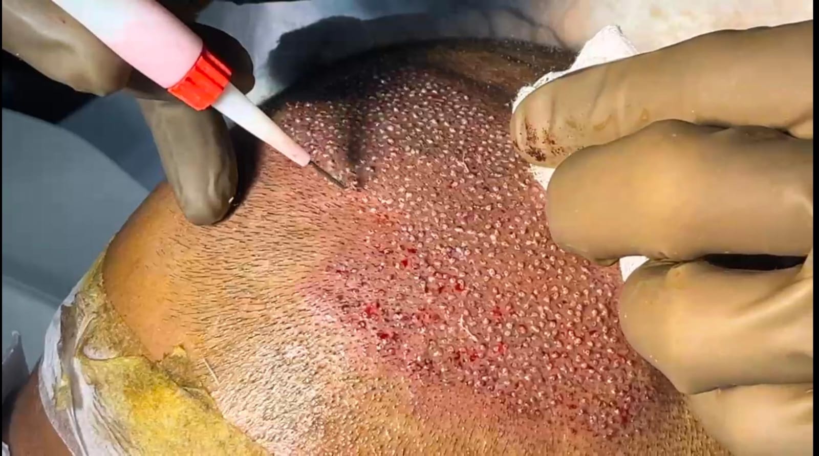 Hair Transplant in Bangalore - VTIARA Clinic