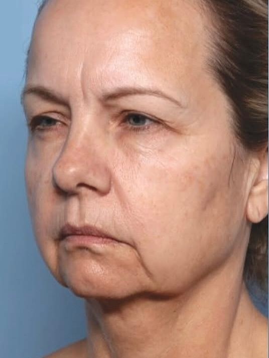 Top Anti-Aging Treatments - VTIARA Clinic Bangalore