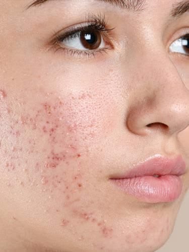 Acne Scar Treatment in Bangalore - VTIARA Clinic