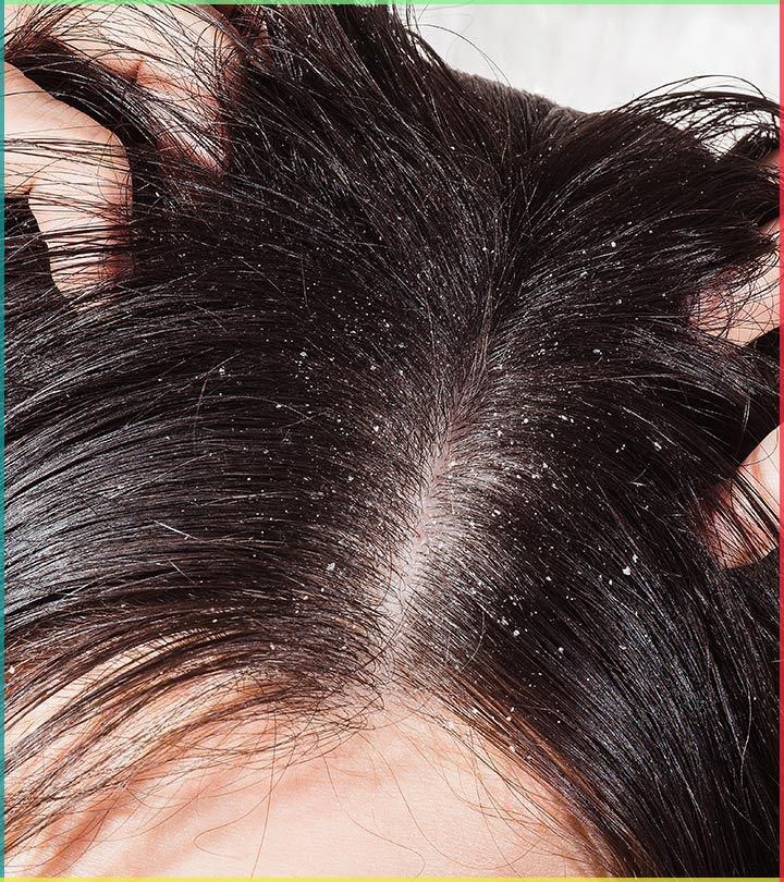 Dandruff Treatment in Bangalore - VTIARA Clinic