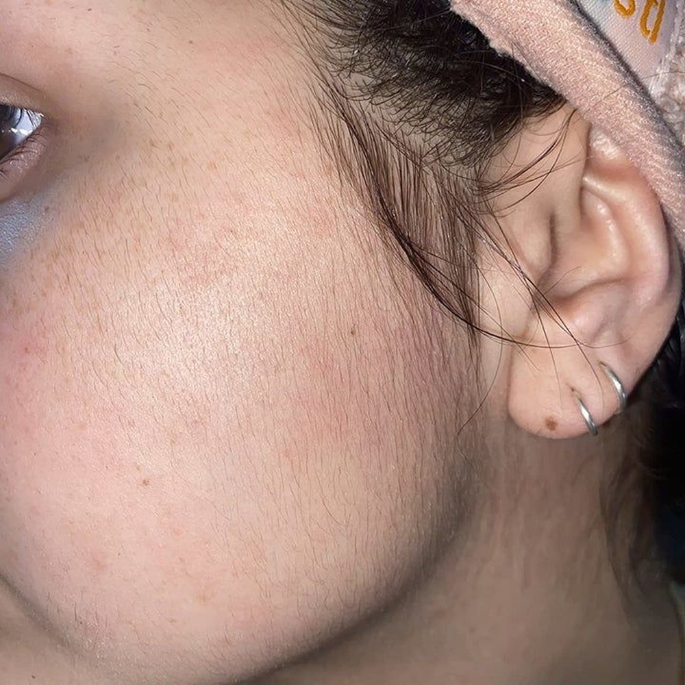 Acne & Scar Treatment in Bangalore - VTIARA Clinic