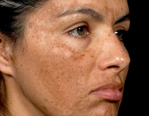 Melasma Treatment in Bangalore - VTIARA Clinic