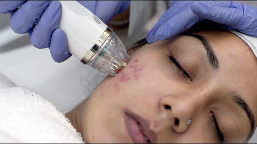 MNRF Treatment in Bangalore - VTIARA Clinic