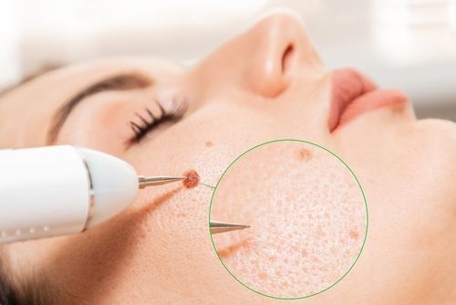 Moles Removal in Bangalore - VTIARA Clinic