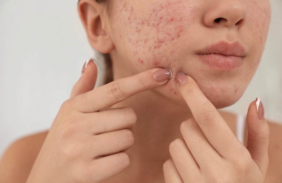Pimple Treatment in Bangalore - VTIARA Clinic
