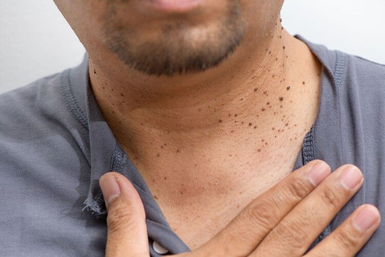Skin Tag Removal in Bangalore - VTIARA Clinic