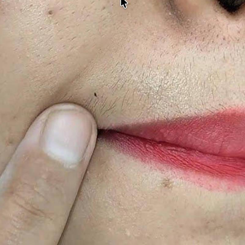 Upper Lip Hair Reduction in Bangalore - VTIARA Clinic