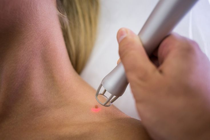 Warts Removal in Bangalore - VTIARA Clinic
